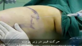 لیزر لیپولیز Slimlipo Laserlipolysis دکتر افسانه ثنایی www.drsanaee.com