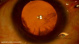 Cataract  Dr. J.S. Lewis  Composites 23G capsulorhexi