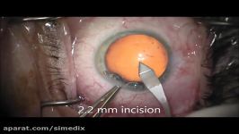 Capsulorhexis Forceps Only Technique