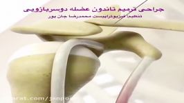 جراحی ترمیم تاندون عضله بایسپس. فیزیوتراپی٠٩١٢٢٦٥٥٦٤٨