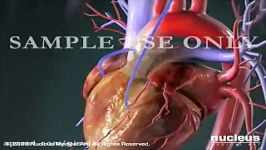 Heart Bypass Surgery CABG