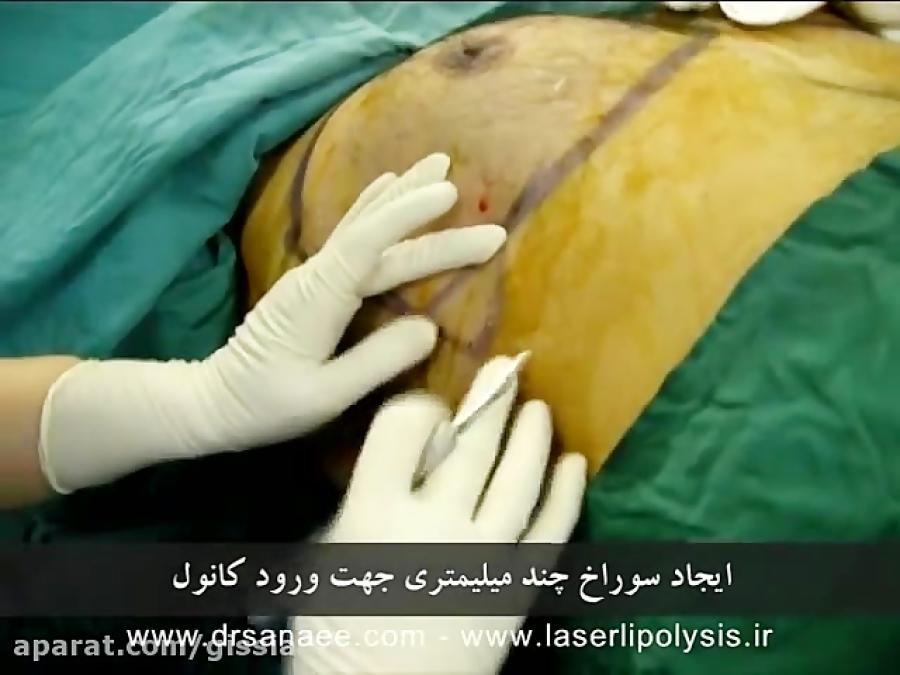 ژنیکو ماستی Gynekomasti دکتر افسانه ثنایی www.drsanaee.com