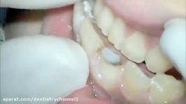 Tooth preparation for All ceramic crown