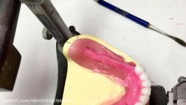 Posterior Denture Tooth Set Up Lingualized Occlusion