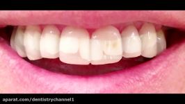 Cosmetic Dentist HATE this VIDEO Invisalign Snap On Smile Dentist too Why