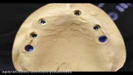 Hybrid Implant Dentures