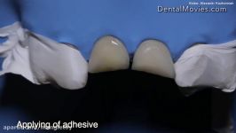 Practical course  Direct restoration of frontal teeth. Step by step.