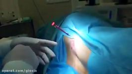 دیسك گردندیسكوژل دیسك گردنفتق دیسك عمل جراحیكمردرد دردهای سیاتیكیدیسك كم
