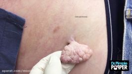 Dr Pimple Popper A pretty big skin tag...