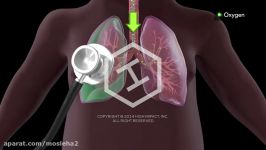 Pneumothorax