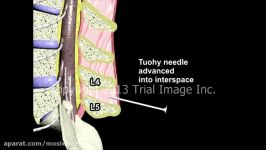 Spinal vs Epidural