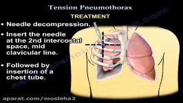 Tension Pneumothorax  Everything You Need To Know  Dr. Nabil Ebraheim