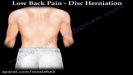 Low Back Pain   Disc Herniation Sciatica  Everything You Need To Know  Dr. Nabil Ebraheim