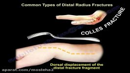 Common Types Of Distal Radius Fractures  Everything You Need To Know  Dr. Nabil Ebraheim