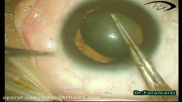 Phaco in Subluxated Lens