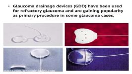 Short Tunnel Small Flap Glaucoma Drainage Devices
