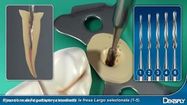 Dentsply CorePost System