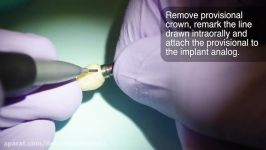 8c. Implants Impression Coping Customization with Blu Mousse