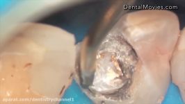 Tooth preparation under microscope  front four esthetic case