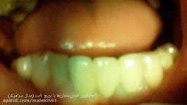 دندانپزشکی زیبایی ترمیمی طرح لبخند هالیوودی مشهد