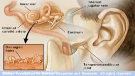 Tinnitus درمان وزوز گوش