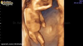 4D ultrasound pregnancy 14 weeks it´s a boy Rafael Ortega Muñoz MD Gynecologist Ciudad Real