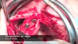 Implant surgery with Microdent implants on anterior pal