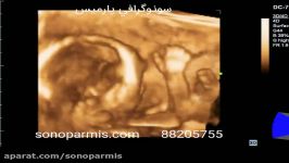 سونوگرافی سه بعدی جنین