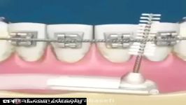 نحوه استفاده مسواک بین دندانی ارتودنسی، دکتر آصفی