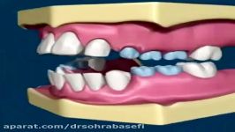 تاثیر مکیدن انگشت بر دندانها، دکتر سهراب آصفی