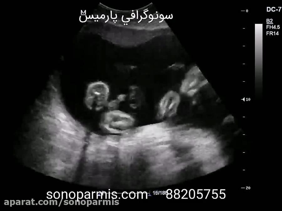 سونوگرافی جنین 27 هفته