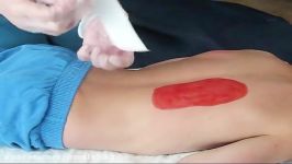 Wound Vac Demonstration