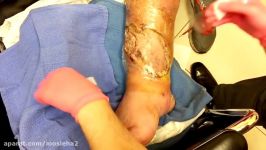 Correct wound VAC technique  DrArthurMiami  negative Pressure wound therapy  limb salvage