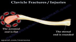 CLAVICLE FRACTURE treatment and repair  Everything You Need To Know  Dr. Nabil Ebraheim