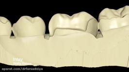 دندانپزشکی زیبایی تاج داندان دندانهای خلفی