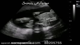 بررسی پاهای جنین 26 هفته