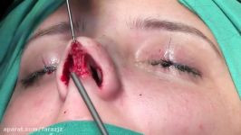 فیلم کامل جراحی زیبایی بینی Nose Plastic Surgery