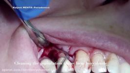 Periodontal surgery with Emdogain