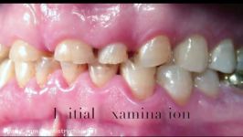 Surgical Crown Lengthening on Severe Tooth Surface Loss.