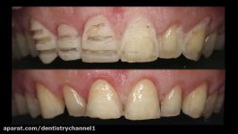 Smile Design  Crown Lengthening  Ceramic Veneers