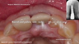 Removal of Failed Dental Implant