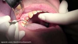 Extraction #5 with Socket Bone Grafting using d PTFE Full Video