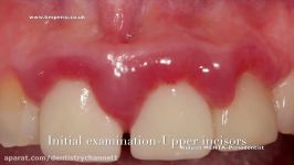 Surgical Crown Lengthening Upper Teeth