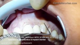 Crown lengthening  Satelec Piezotome 2