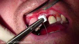 Extraction #8 with Socket Grafting II Suturing Technique