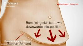 جراحی زیبایی شکم تامی تاک Abdominoplasty