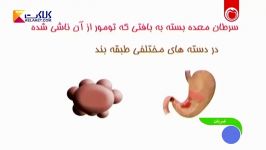 علل،علائم درمان بدخیمی معده