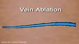 Vein ablation تخریب وریدی