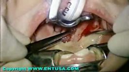 Peritonsillar Abscess Drainage