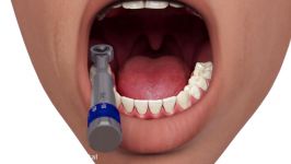 Multi unit abutment open tray technique biohorizons